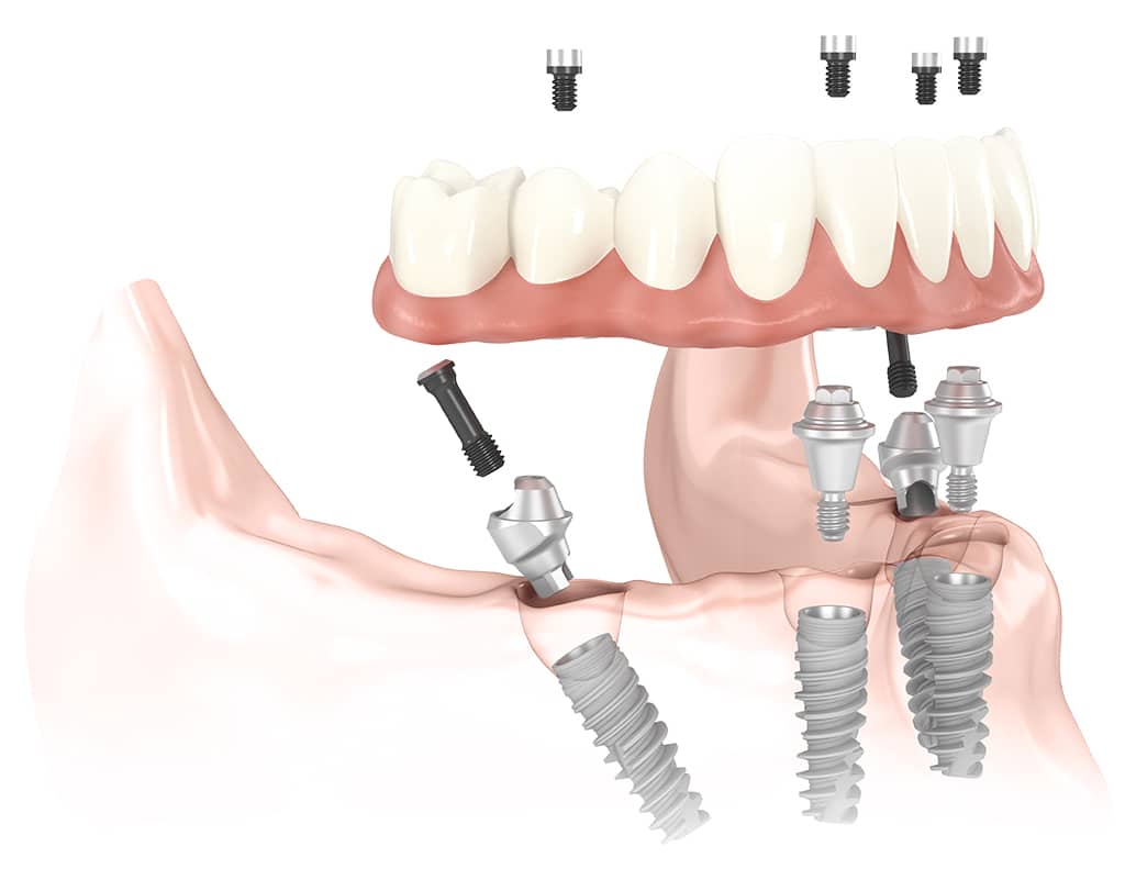 A fixed bridge being placed over four strategically positioned Titanium dental implants
