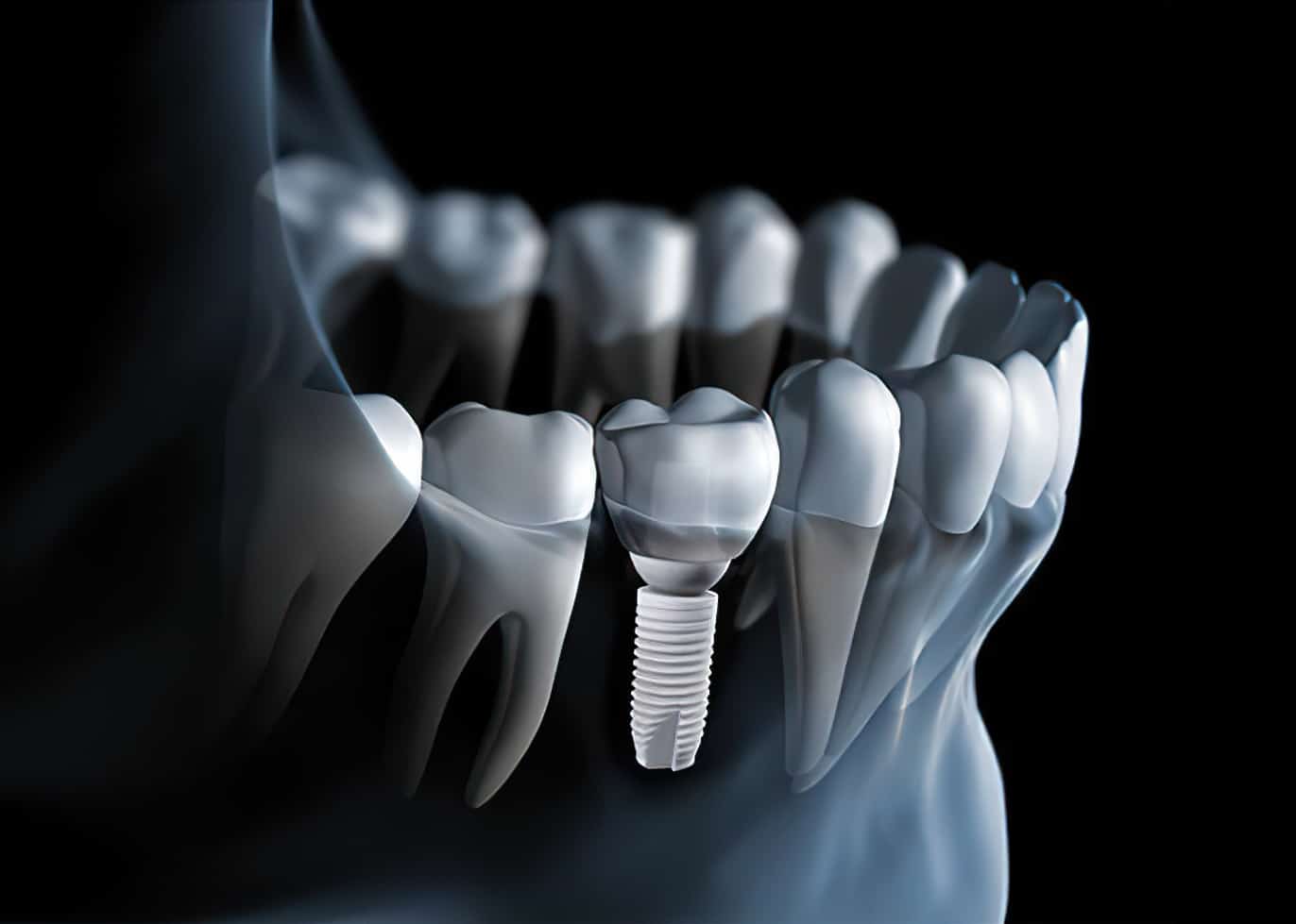 A metal-free zirconium dental implant, showcasing advanced technology for natural-looking and biocompatible tooth replacement.