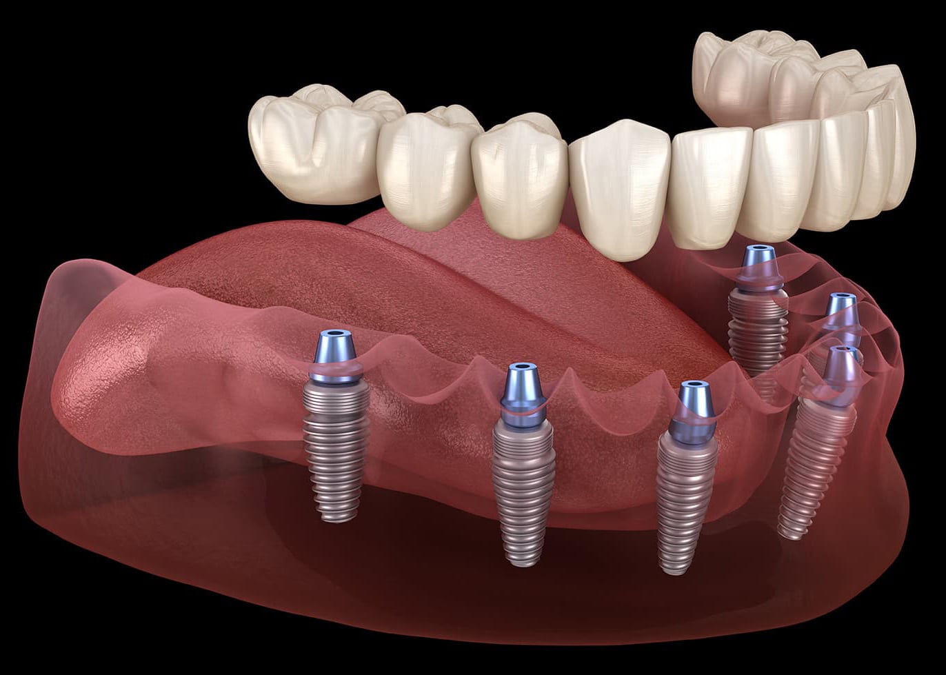 Same day temporary crown is placed over the embedded immediate load implants