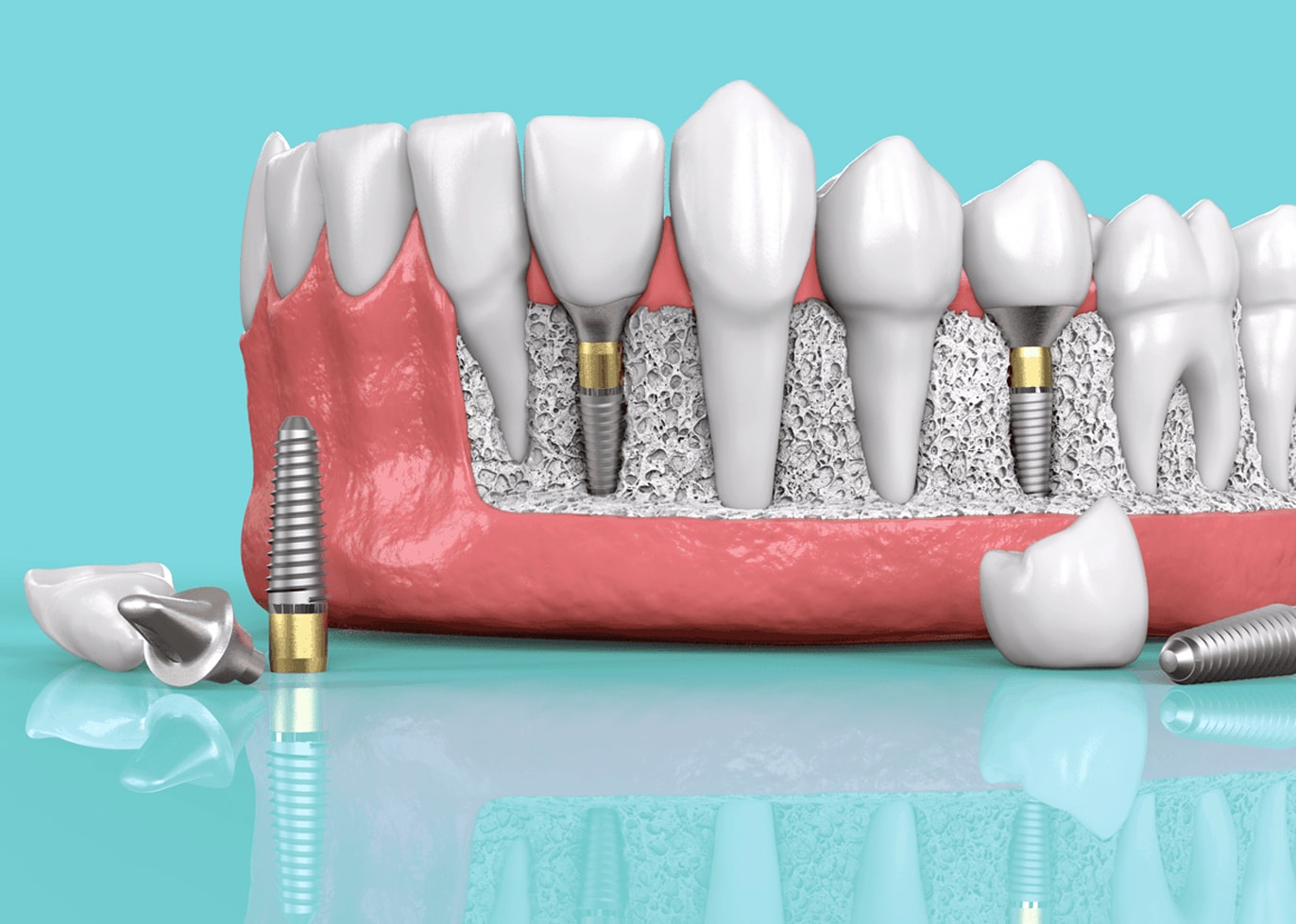 Dental implant procedure featuring two-stage or delayed loading technique in individual implant cases.